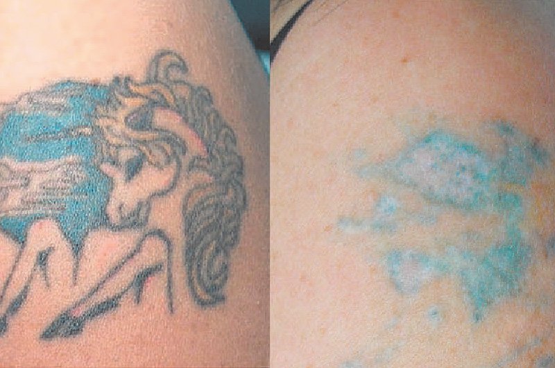 Red/Green/Blue Tattoo Removal – Tattoo Removal Kochi
